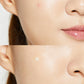 Acne Pimple Master (24 parches)